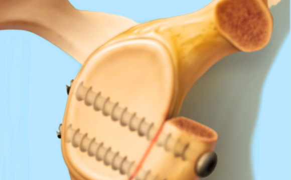 Stabilizare anterioara coracoidiană Latarjet