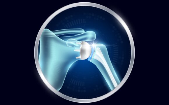 proteza inversata umar