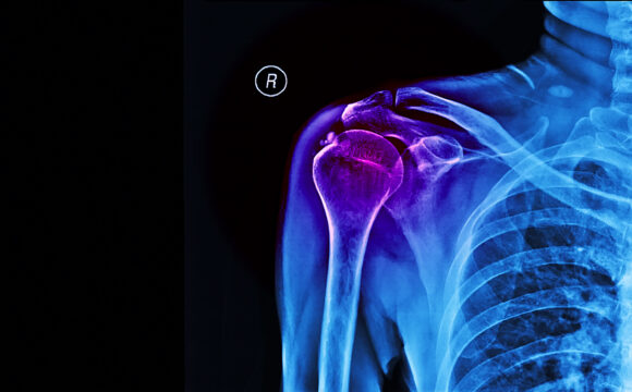 Calcificarile umărului