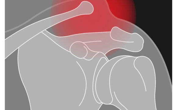 Ligamentoplastie coraco-claviculară