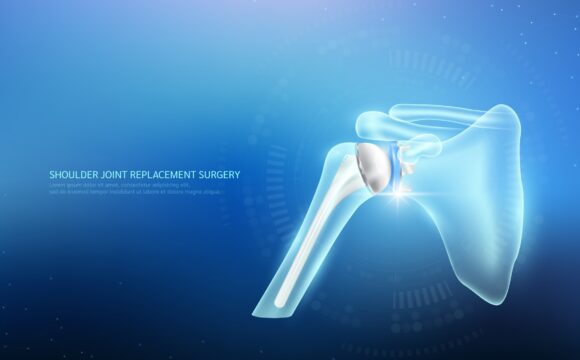 Proteză anatomică de umăr