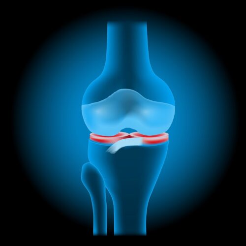 Leziunile meniscale