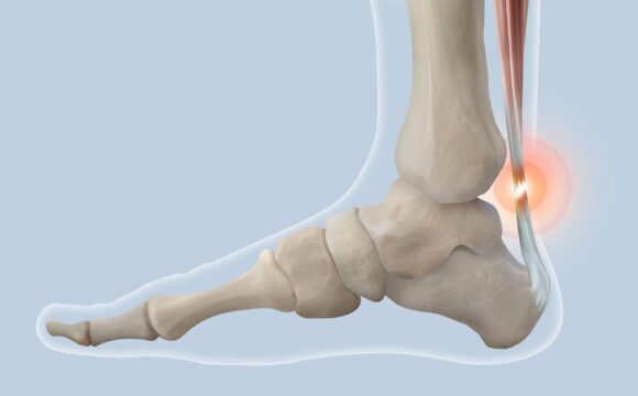 Repararea tendonului Ahile