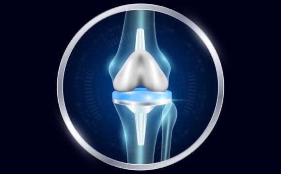 Artroplastia totala de genunchi