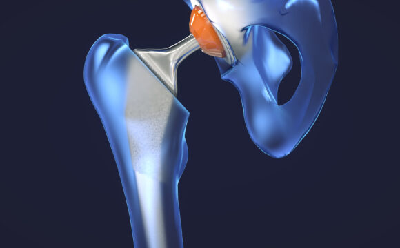 Artroplastia totala sold