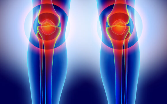 Sindrom femuro-patelar